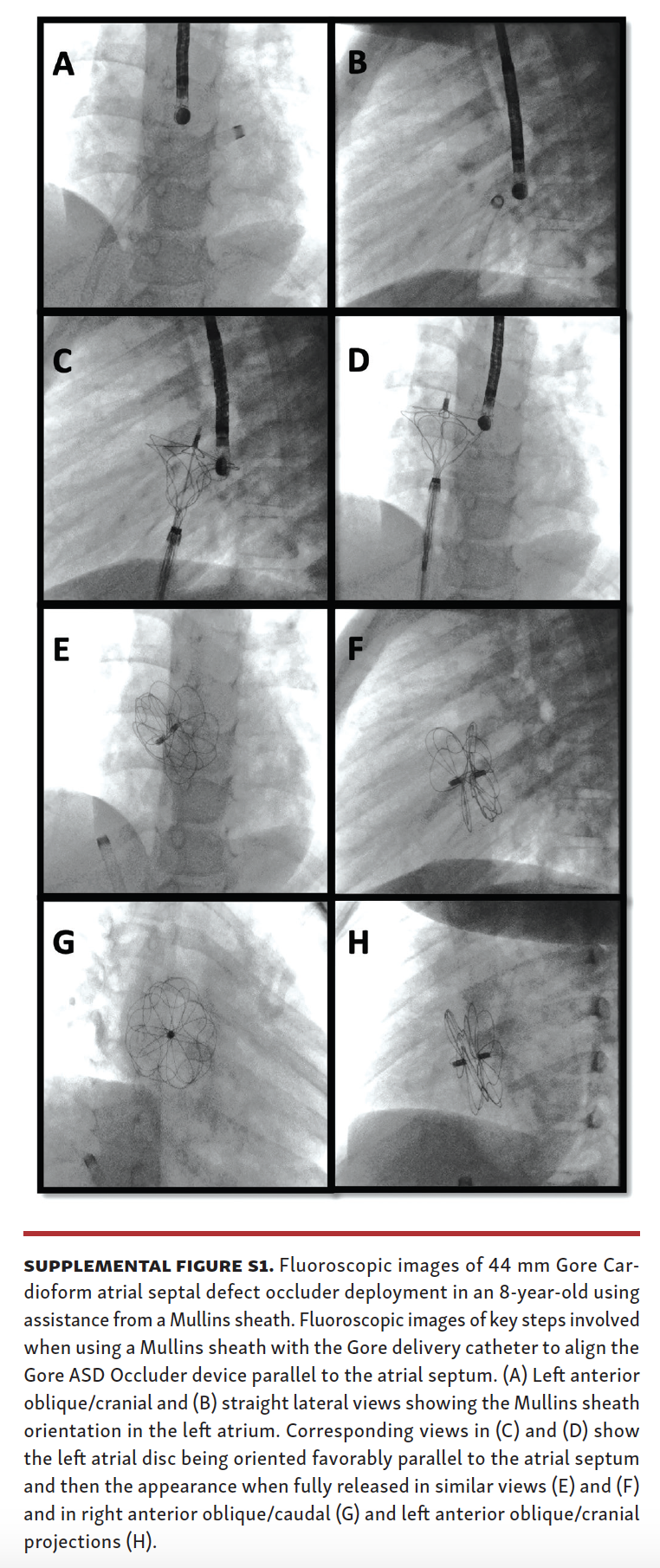 MullinsSheath Facilitated Delivery of Gore Cardioform ASD Occluder
